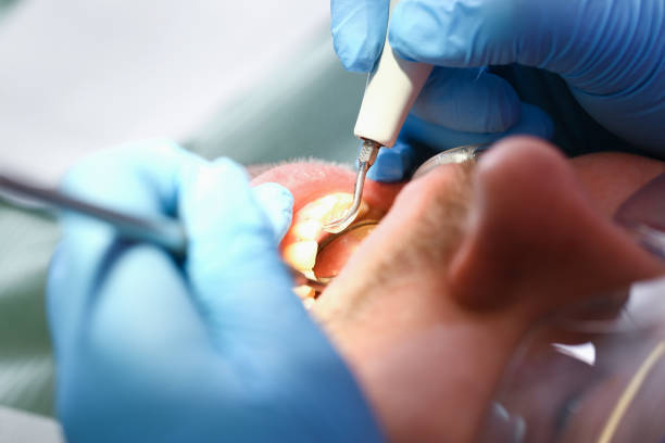 Best Lost Filling or Crown Replacement in Mchenry, IL